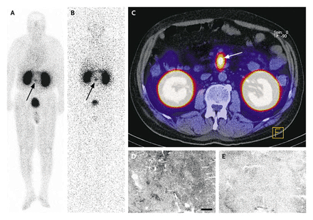 Receptor Imaging of an Insulinoma in Patient 1