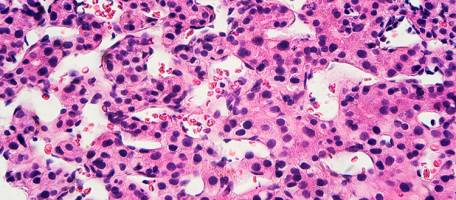 Cancer du foie: attention � l'h�patite D