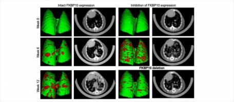 Une nouvelle cible mol�culaire contre des cancers agressifs