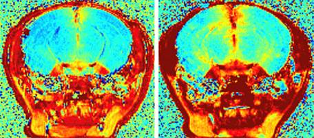 Vers des immunoth�rapies avec moins d'effets secondaires