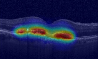 KI könnte bald Ihre Augenarzt-Termine mitbestimmen