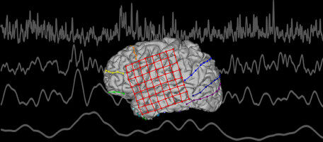 Decoding inner language to treat speech disorders