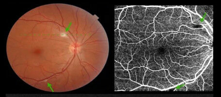 La r�tine n'est pas �pargn�e par le SARS-CoV-2