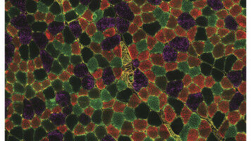Le blocage des sphingolipides empêche la dystrophie musculaire