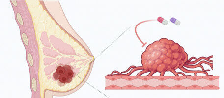 Vaincre les r�sistances au traitement du cancer du sein