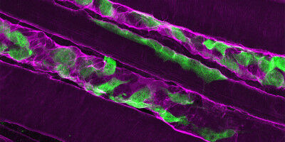 Congenital muscle weakness: Muscles fail to regenerate