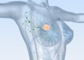 Synthetic stress hormone dexamethasone could reduce breast cancer metastases