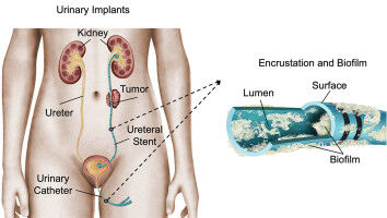 Ultrasound and cilia to clean implanted stents and catheters