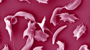 Alzheimer's Drug Demonstrates Efficacy Against Sickle Cell Anemia