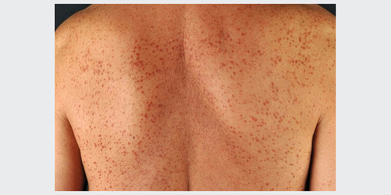 Lesioni cutanee tipiche della mastocitosi. Uno studio di Basilea dimostra che: L