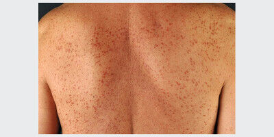 KI hilft, Hautl�sionen bei seltener Krankheit genauer zu bewerten