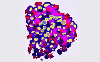 IA per prevedere il rischio di metastasi del cancro