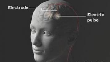 New funding for brain stimulation