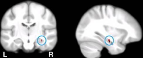 Den Ursachen von Alzheimer auf der Spur