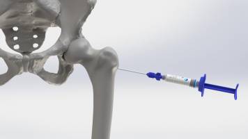 Flowbone can help prevent bone fractures caused by osteoporosis