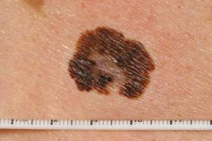 Krebstumore zur Selbstverdauung zwingen