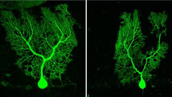 Mechanismus bei degenerativen Hirnerkrankungen entdeckt