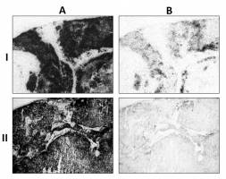 Neue Diagnose und Therapiem�glichkeit f�r Brust- und Nierenkrebs