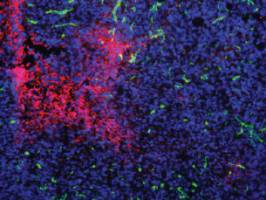 Neue Entdeckung im Kampf gegen Krebs: Tumorzellen stellen Betrieb um