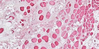 Treating muscular disease - Santhera and Biozentrum join forces