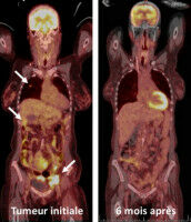 Un cancer tr�s agressif vaincu en trois mois
